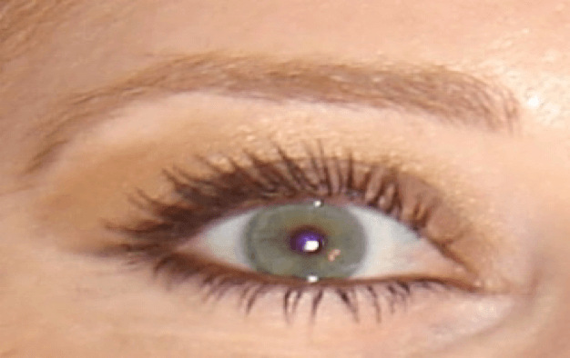 Advanced Dry Eye Therapies Using Your Own Blood